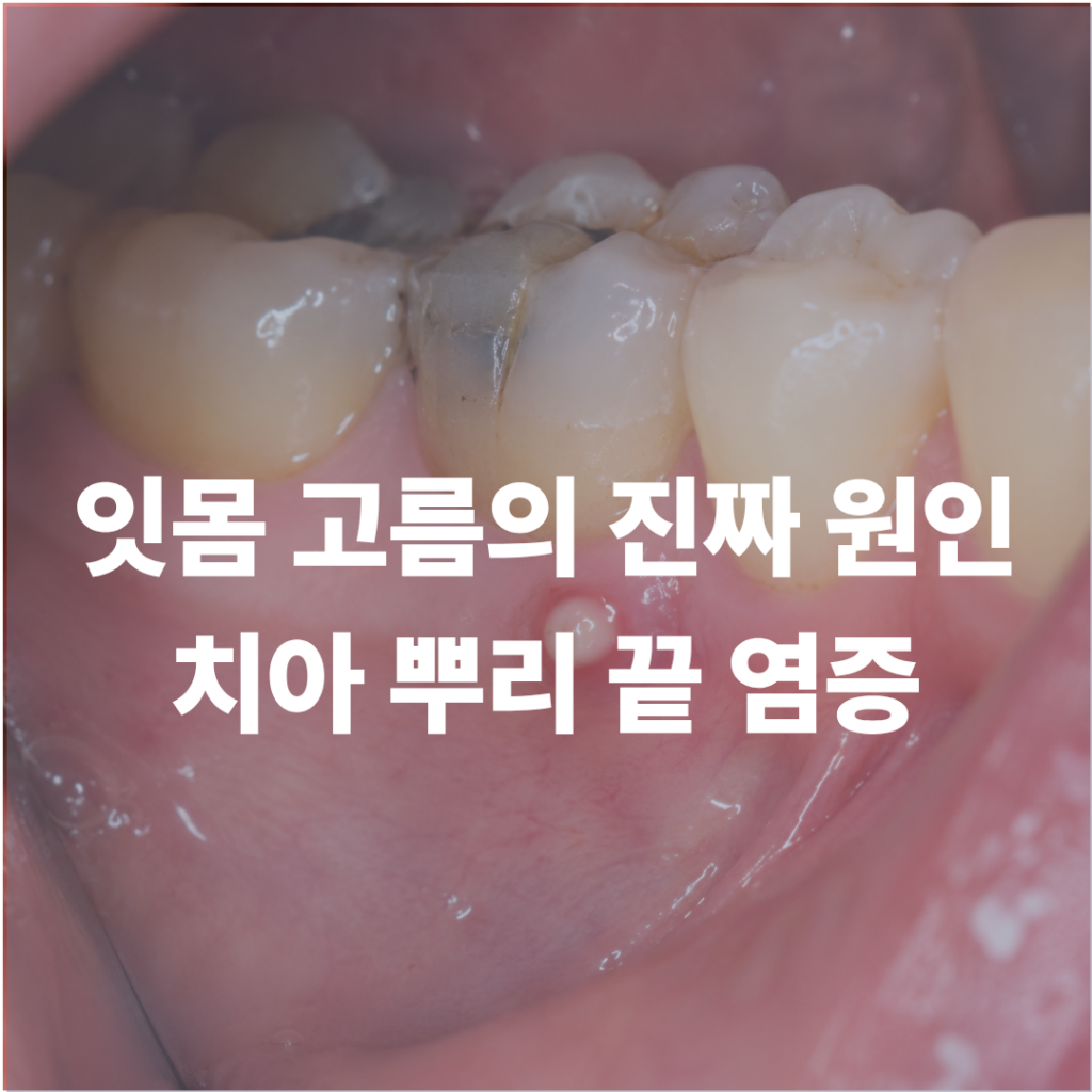 잇몸에 고름이 생겼다면? 원인은 잇몸이 아닌 치아에 있을 수 있습니다