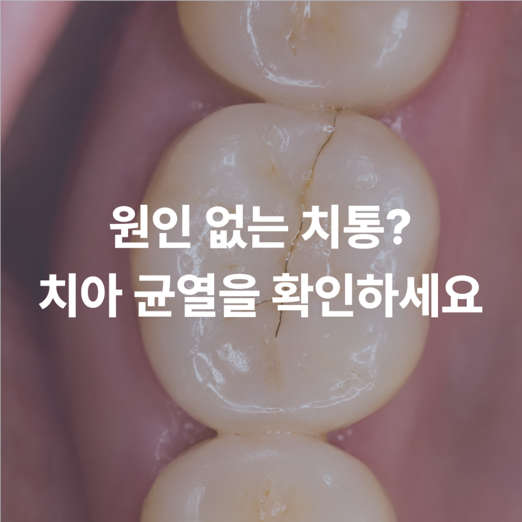 충치는 없는데 이가 욱신거린다면? 의외로 많은 사람들이 놓치는 치아 균열 이야기