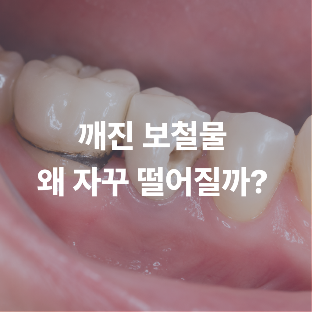 깨진 보철물, 다시 붙여도 자꾸 떨어진다면? 원인과 해결 방법 알아보기
