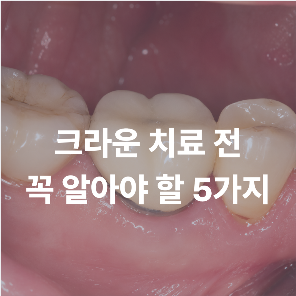 크라운 치료 후 후회하는 이유? 치료 전 꼭 알아야 할 5가지