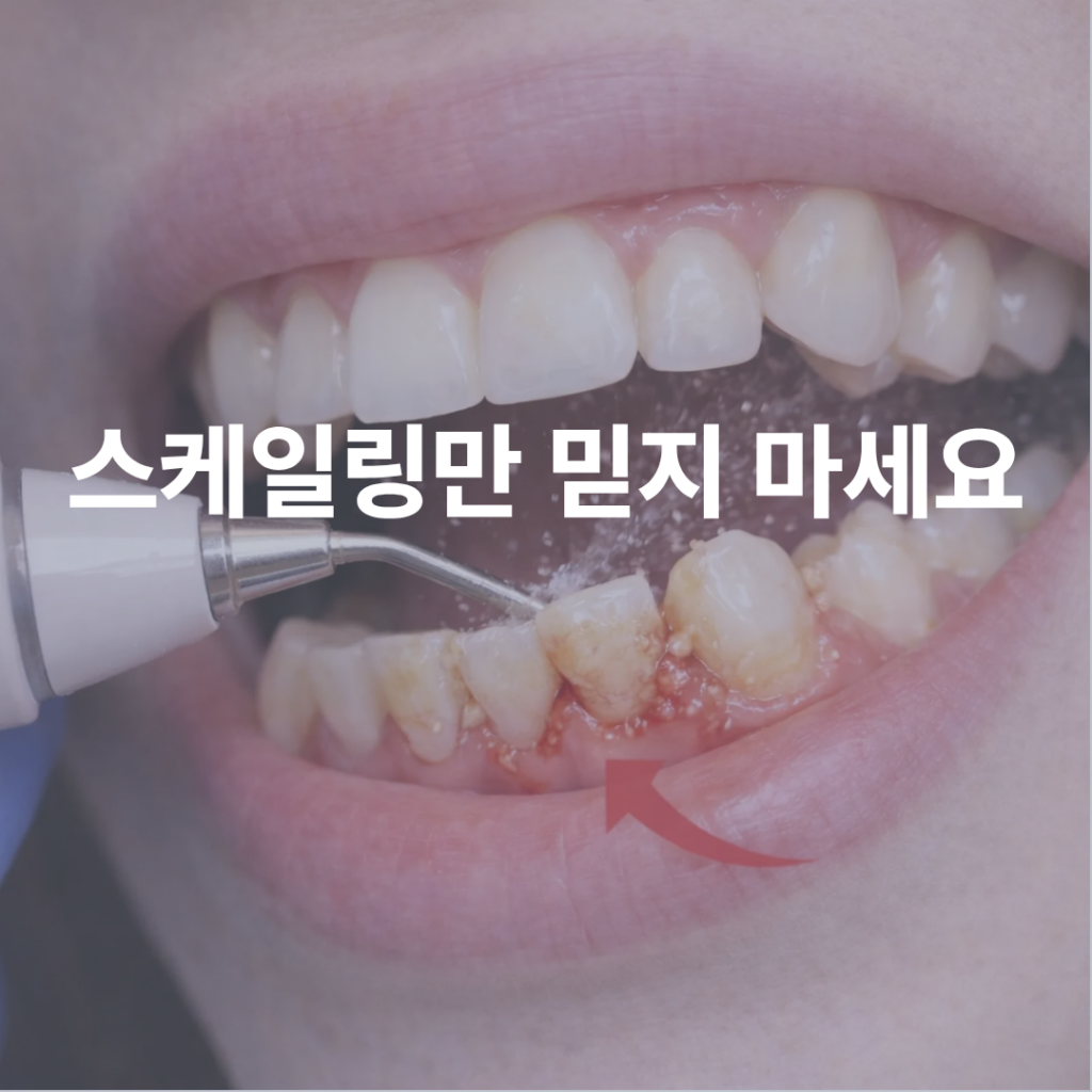 스케일링만 받아도 잇몸 염증이 좋아질까요? 치료가 더 필요한 순간도 있습니다