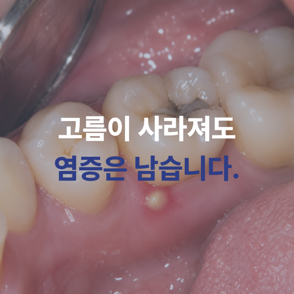 잇몸 고름이 터졌다면 괜찮을까요? 치과에서 확인해야 하는 이유