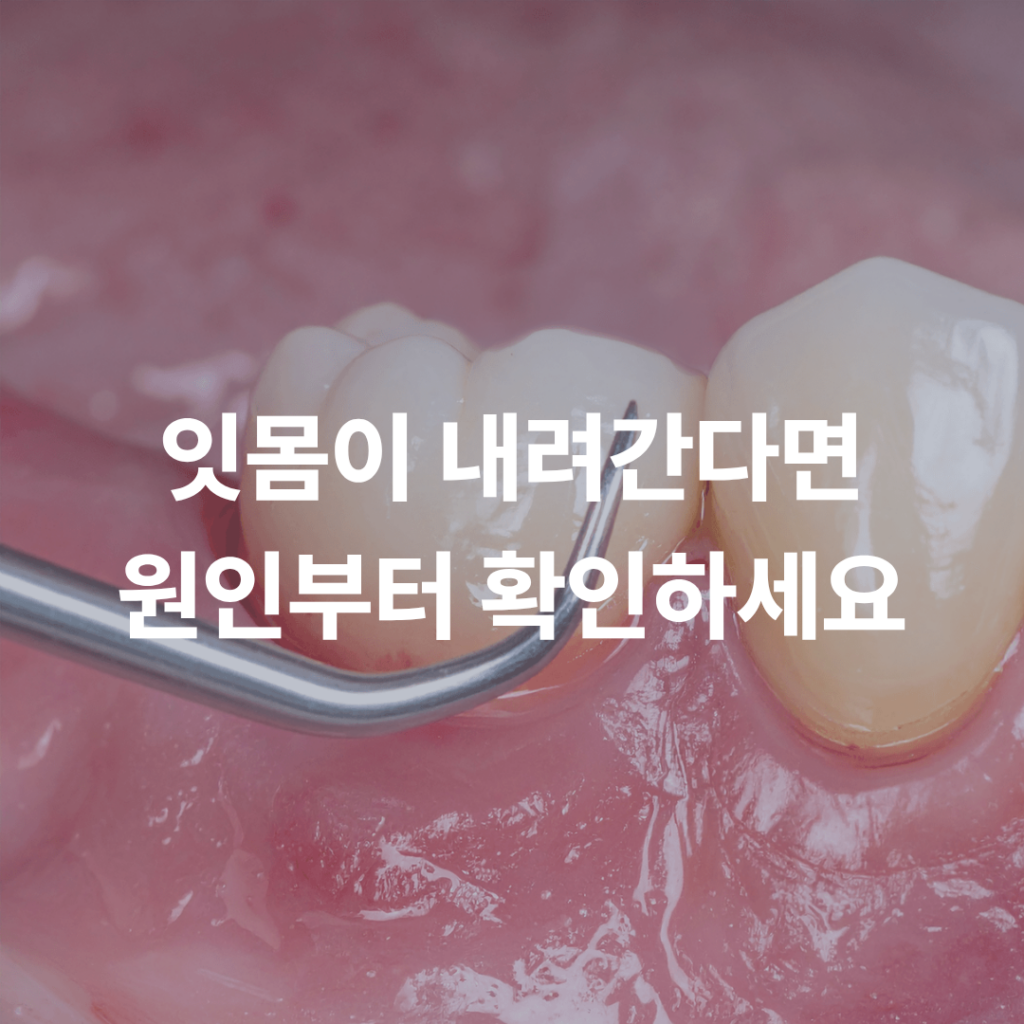 잇몸이 내려앉아 치아가 길어 보인다면? 잇몸퇴축 원인부터 확인하세요
