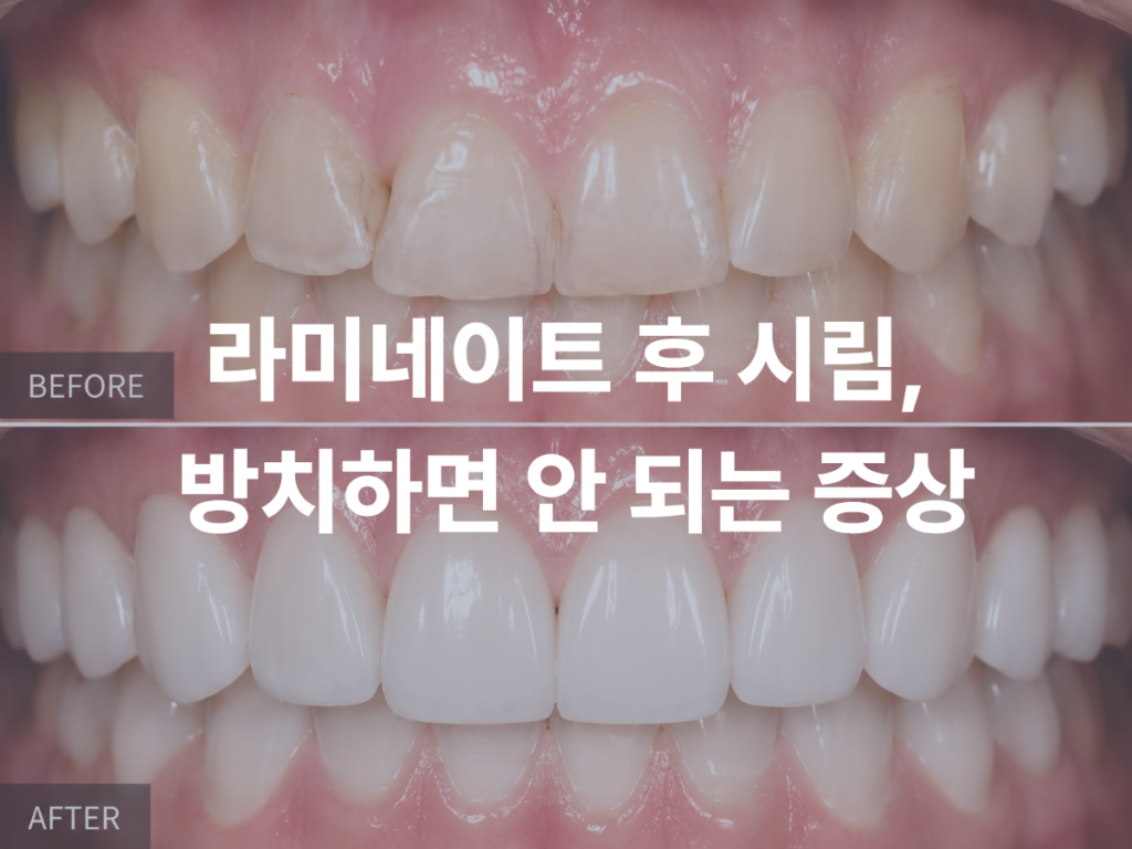 라미네이트 후 치아 시림, 언제 치과를 찾아야 할까요?